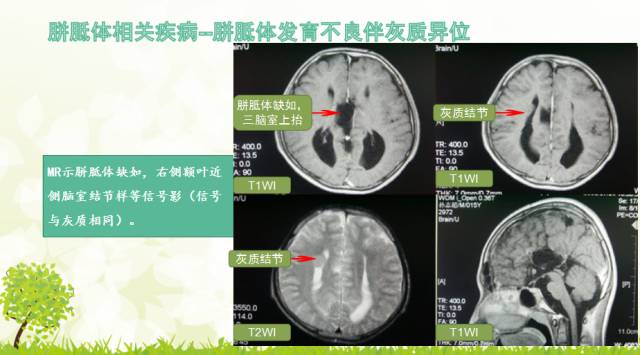 【PPT】胼胝体影像学
