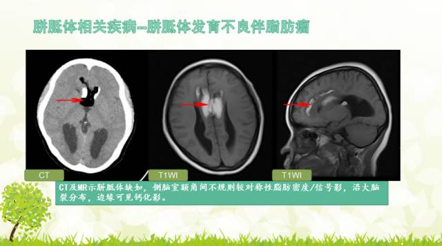 【PPT】胼胝体影像学