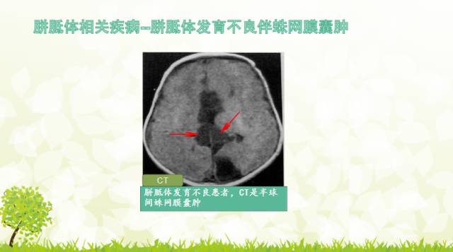 【PPT】胼胝体影像学