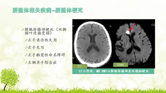 【PPT】胼胝体影像学