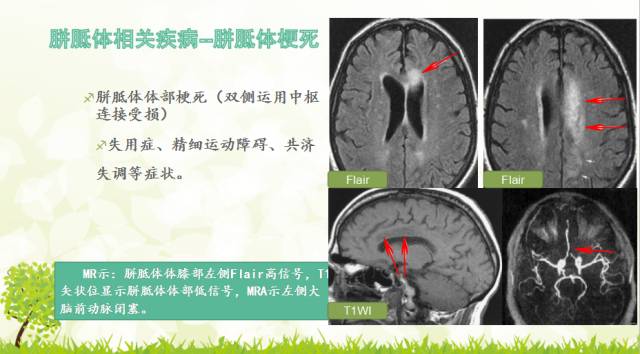 【PPT】胼胝体影像学