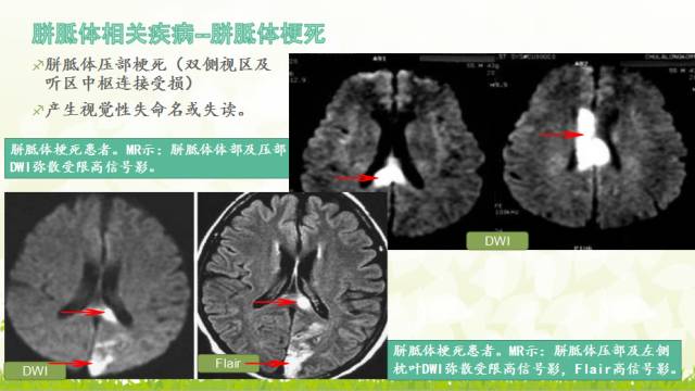 【PPT】胼胝体影像学