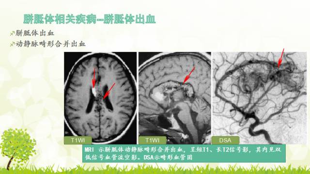 【PPT】胼胝体影像学
