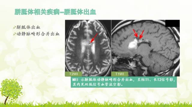 【PPT】胼胝体影像学