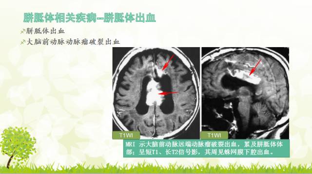 【PPT】胼胝体影像学