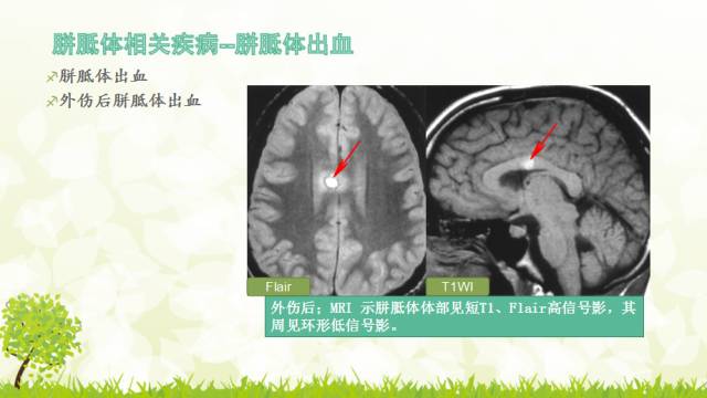 【PPT】胼胝体影像学