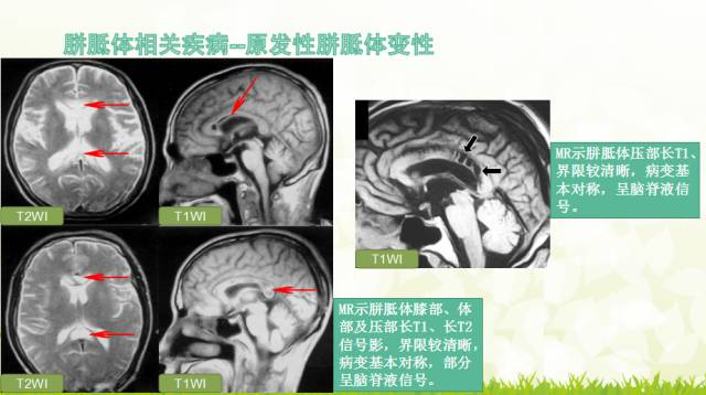 【PPT】胼胝体影像学