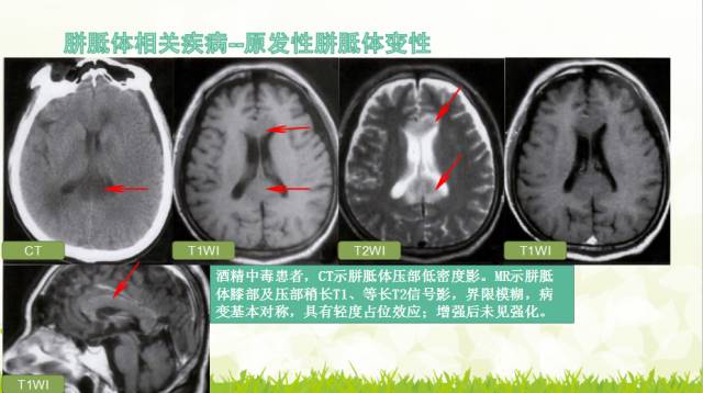 【PPT】胼胝体影像学