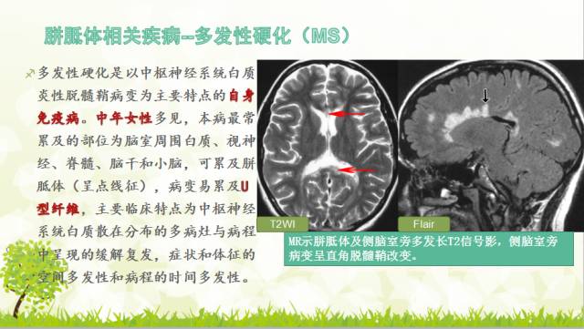 【PPT】胼胝体影像学
