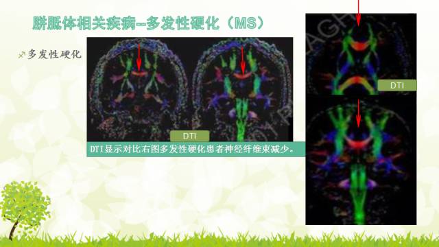 【PPT】胼胝体影像学