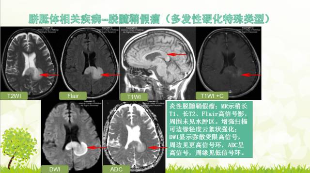 【PPT】胼胝体影像学
