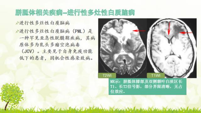 【PPT】胼胝体影像学