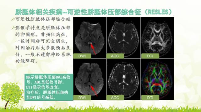 【PPT】胼胝体影像学
