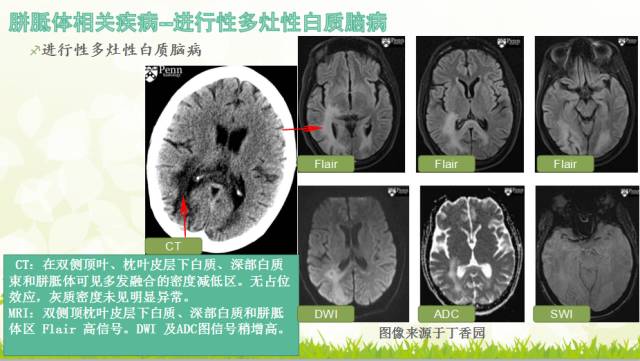 【PPT】胼胝体影像学