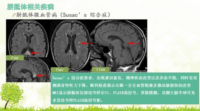 【PPT】胼胝体影像学
