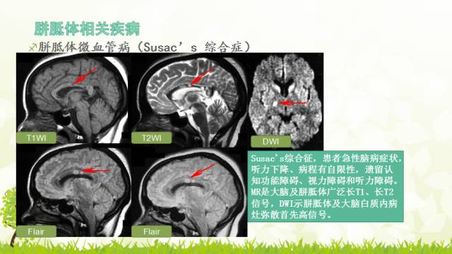 【PPT】胼胝体影像学