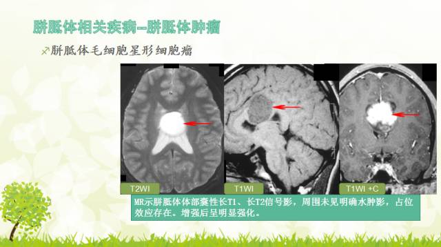 【PPT】胼胝体影像学