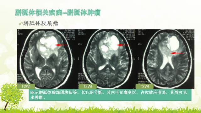 【PPT】胼胝体影像学