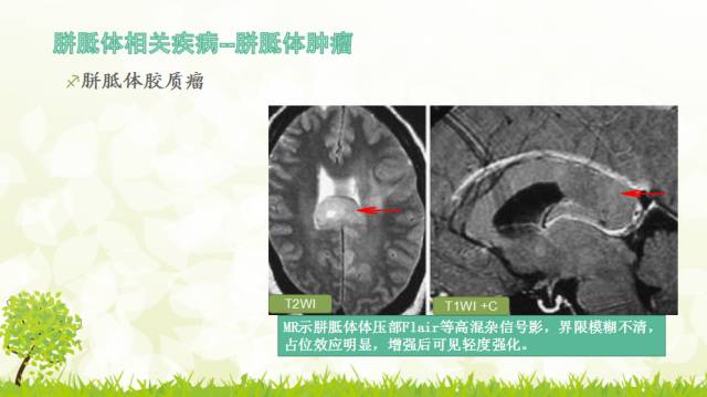 【PPT】胼胝体影像学