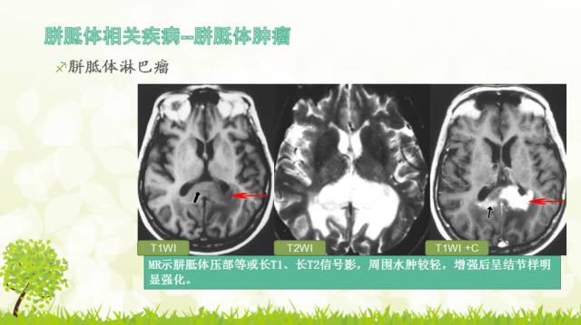【PPT】胼胝体影像学