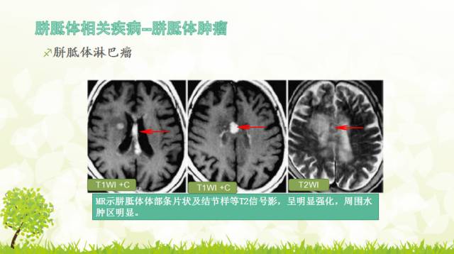 【PPT】胼胝体影像学