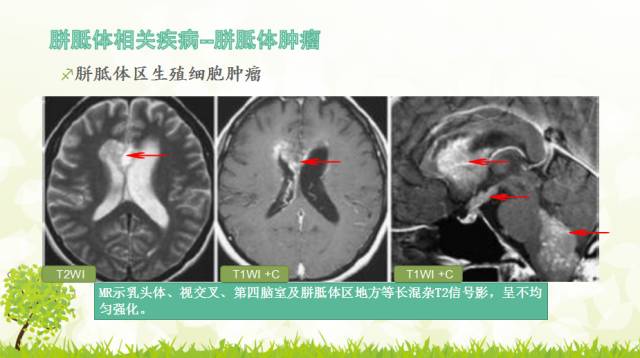 【PPT】胼胝体影像学
