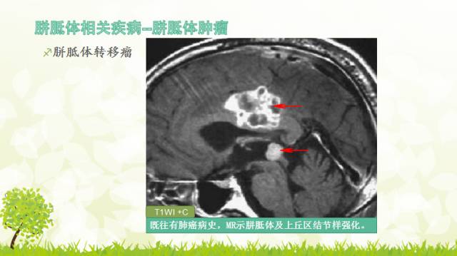 【PPT】胼胝体影像学