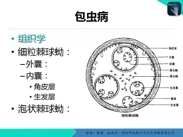 【PPT】肝包虫病