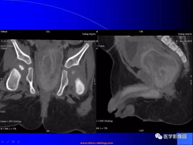 【病例】盆腔胚胎性横纹肌肉瘤1例CT影像表现 【病例】盆腔胚胎性横纹肌肉瘤1例CT影像表现