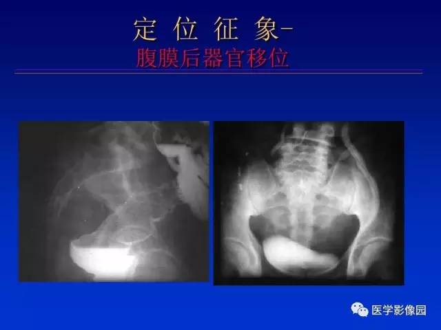 【PPT】原发腹膜后肿瘤影像表现及鉴别诊断思路