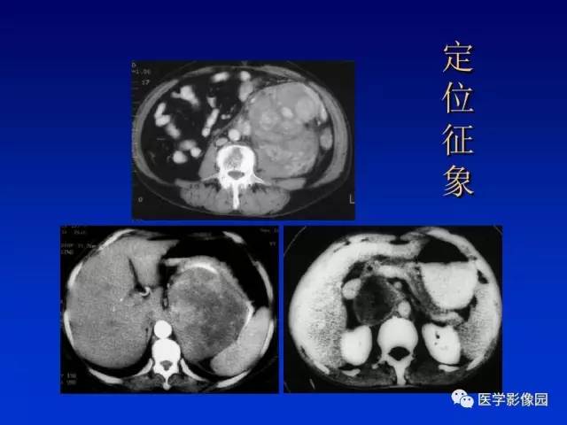 【PPT】原发腹膜后肿瘤影像表现及鉴别诊断思路
