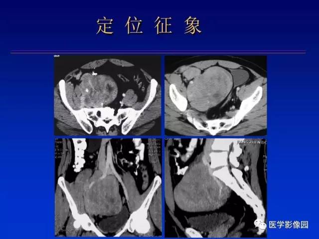 【PPT】原发腹膜后肿瘤影像表现及鉴别诊断思路