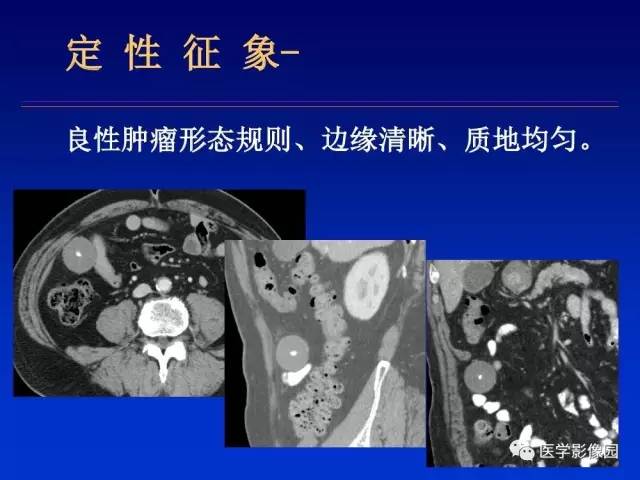 【PPT】原发腹膜后肿瘤影像表现及鉴别诊断思路