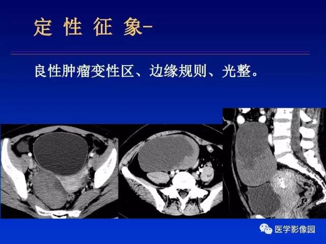 【PPT】原发腹膜后肿瘤影像表现及鉴别诊断思路