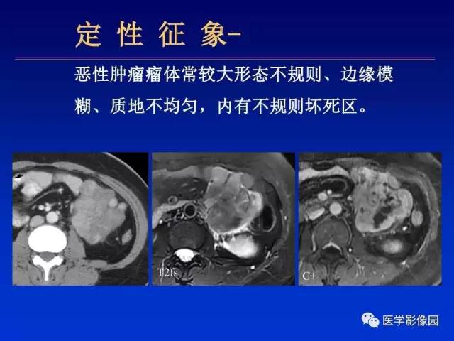 【PPT】原发腹膜后肿瘤影像表现及鉴别诊断思路