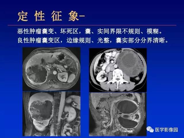 【PPT】原发腹膜后肿瘤影像表现及鉴别诊断思路