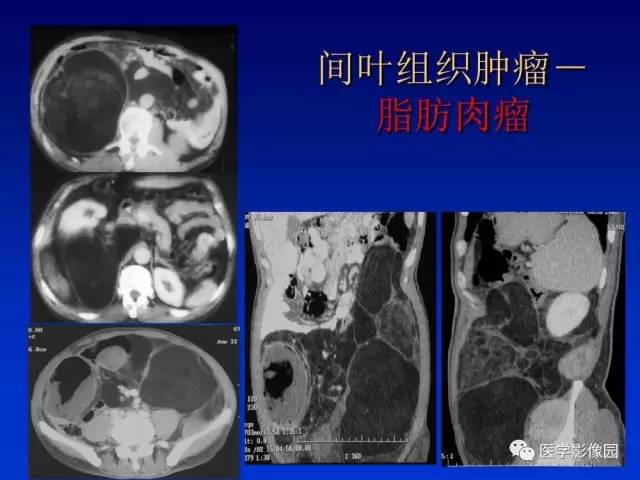 【PPT】原发腹膜后肿瘤影像表现及鉴别诊断思路