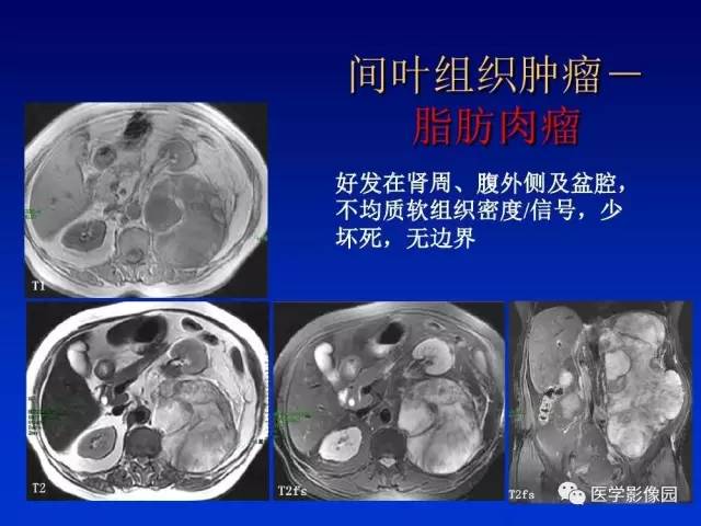 【PPT】原发腹膜后肿瘤影像表现及鉴别诊断思路