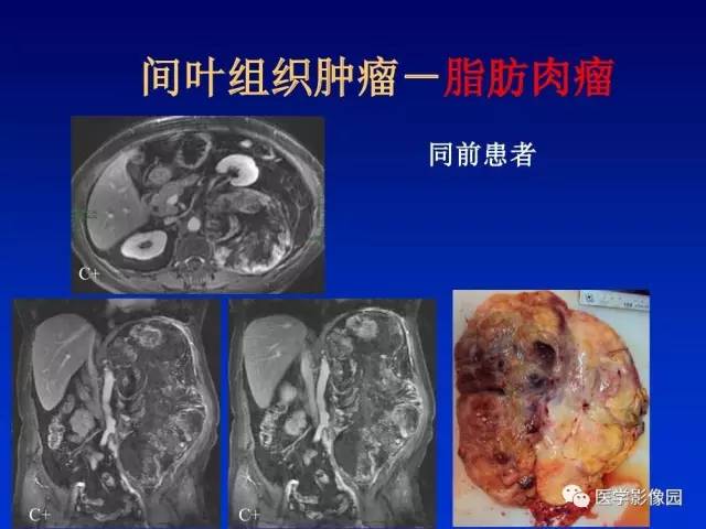 【PPT】原发腹膜后肿瘤影像表现及鉴别诊断思路