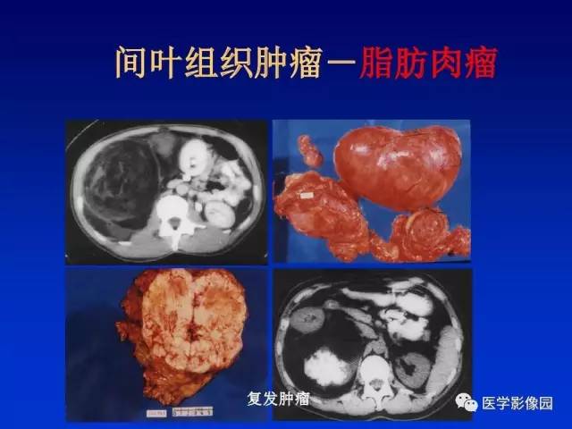 【PPT】原发腹膜后肿瘤影像表现及鉴别诊断思路