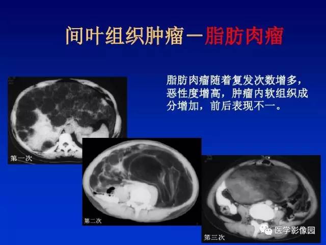 【PPT】原发腹膜后肿瘤影像表现及鉴别诊断思路