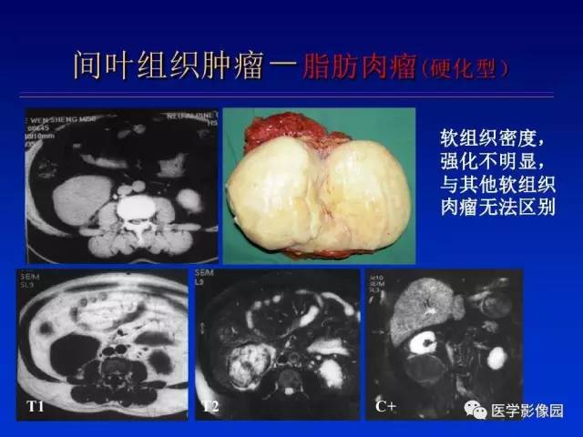 【PPT】原发腹膜后肿瘤影像表现及鉴别诊断思路