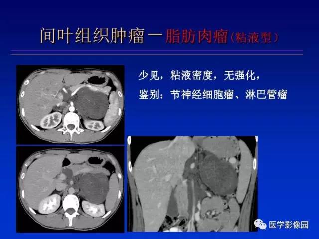 【PPT】原发腹膜后肿瘤影像表现及鉴别诊断思路