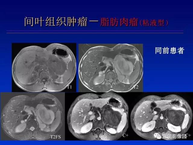 【PPT】原发腹膜后肿瘤影像表现及鉴别诊断思路