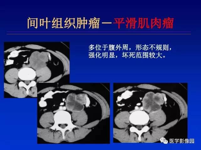 【PPT】原发腹膜后肿瘤影像表现及鉴别诊断思路