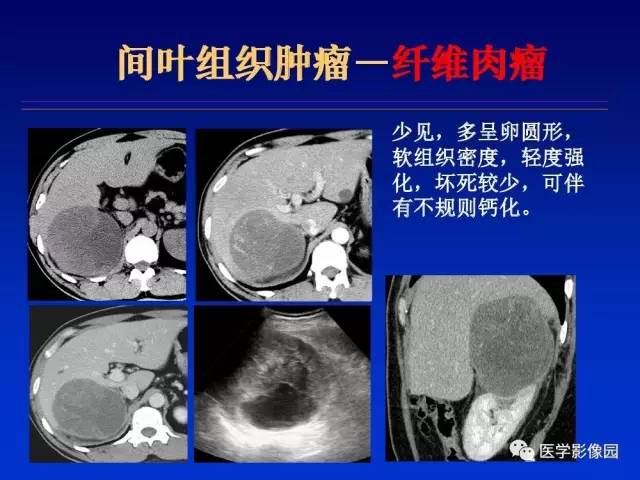 【PPT】原发腹膜后肿瘤影像表现及鉴别诊断思路