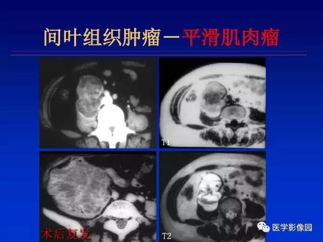 【PPT】原发腹膜后肿瘤影像表现及鉴别诊断思路