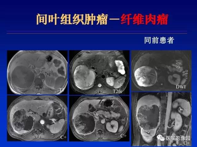 【PPT】原发腹膜后肿瘤影像表现及鉴别诊断思路