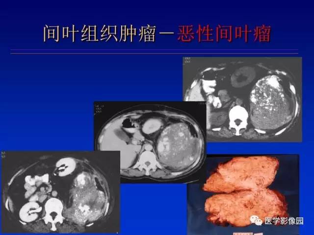【PPT】原发腹膜后肿瘤影像表现及鉴别诊断思路