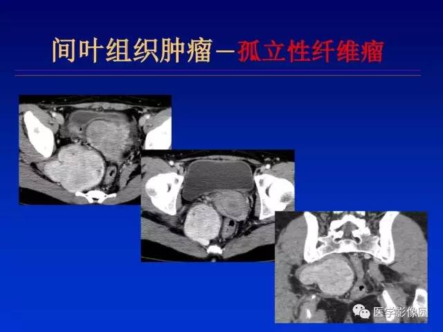 【PPT】原发腹膜后肿瘤影像表现及鉴别诊断思路